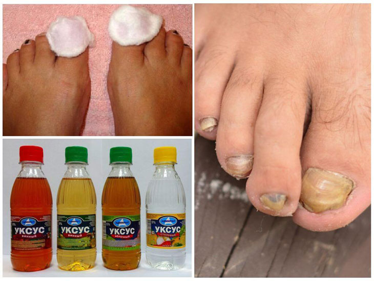 Грибок ногтей на ногах лечение народными средствами уксус яйцо thumbnail