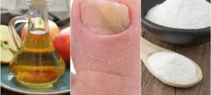 Лечение грибка ногтей яблочным уксусом